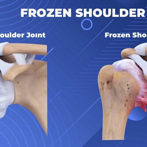 Frozen Shoulder