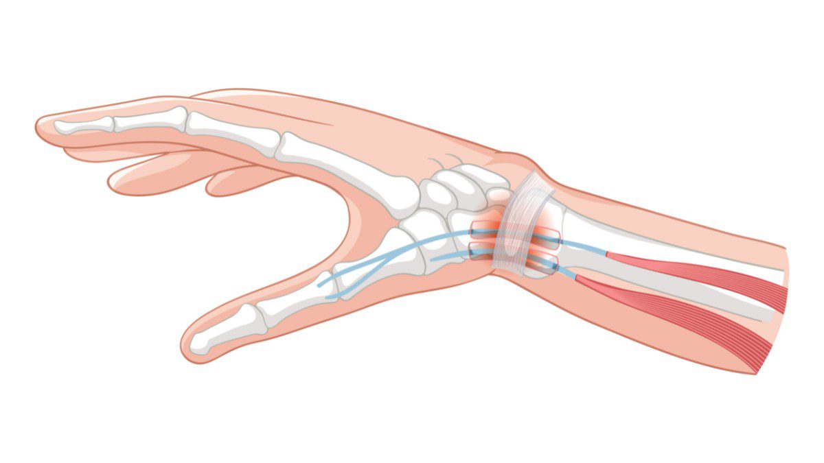 Thumb Ligament Surgery in Miami: Restoring Grip Strength