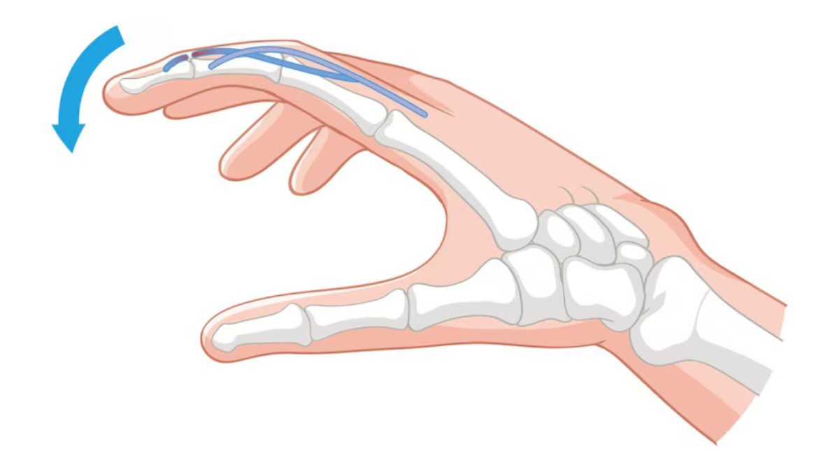 Thumb Ligament Surgery in Miami