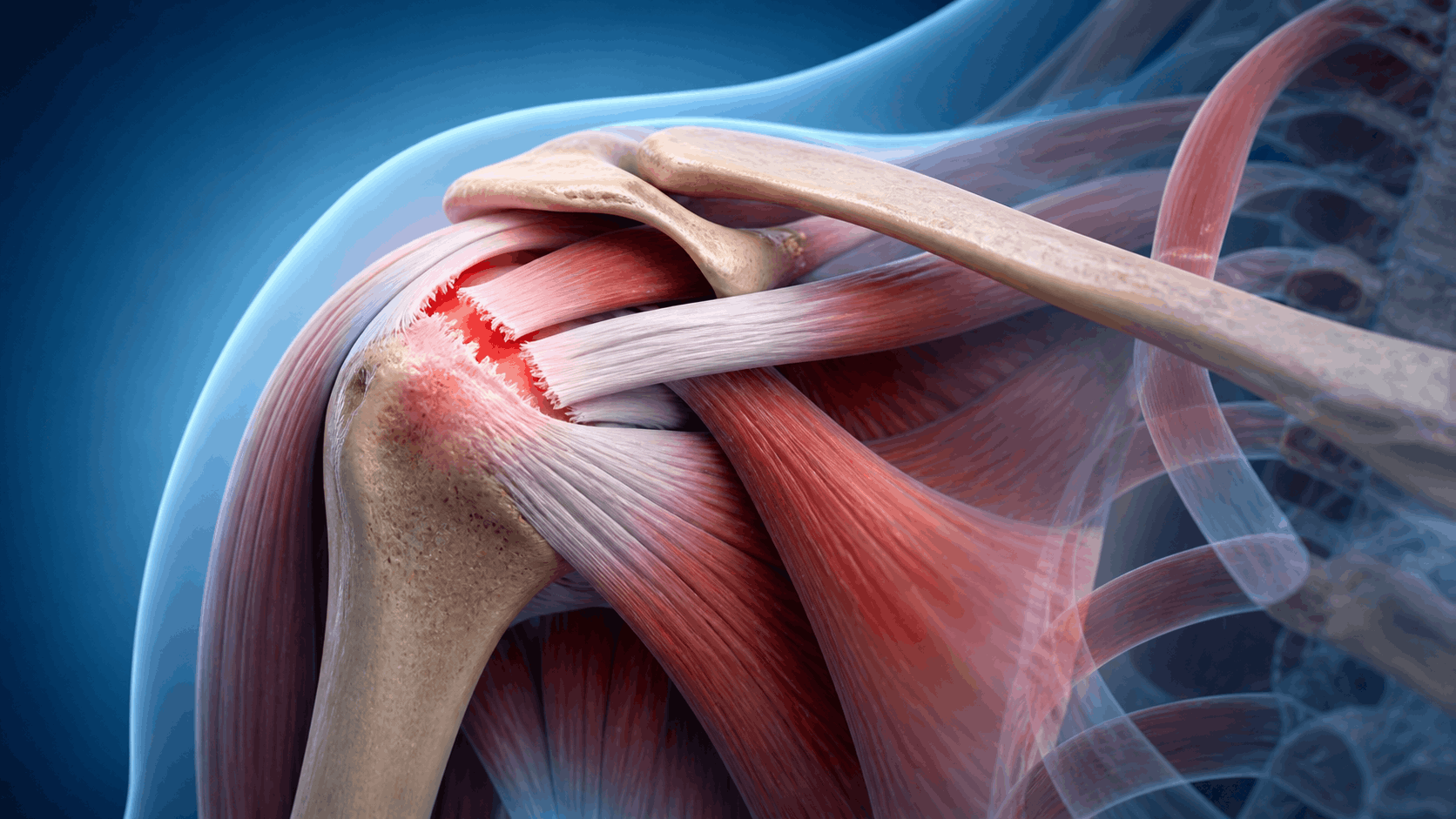 Shoulder Tendon Treatment Miami