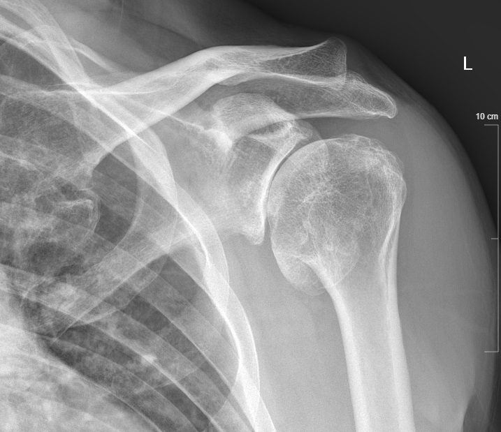 About Shoulder Arthritis