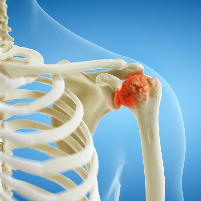 Image of Shoulder arthritis