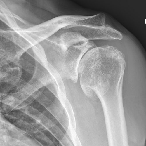 Shoulder Injury