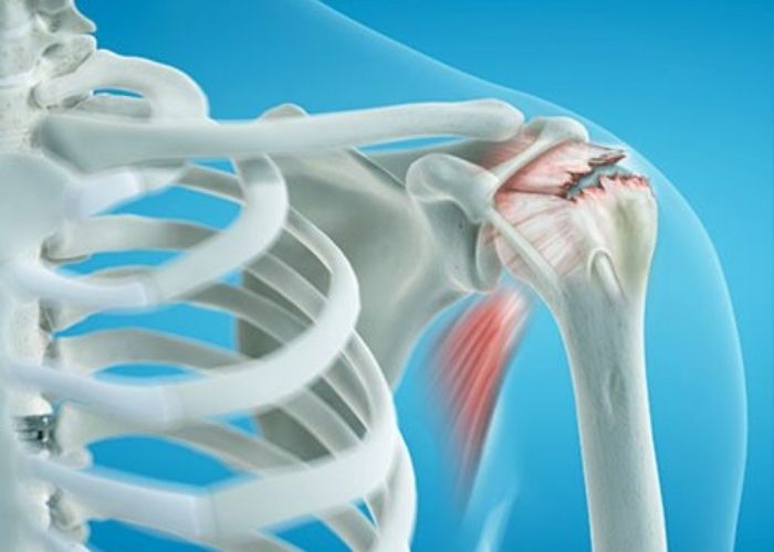 Shoulder Injury