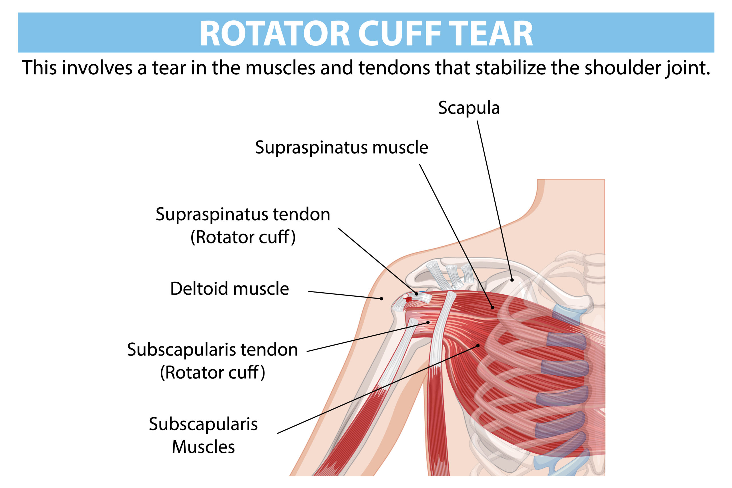 rotator cuff tear