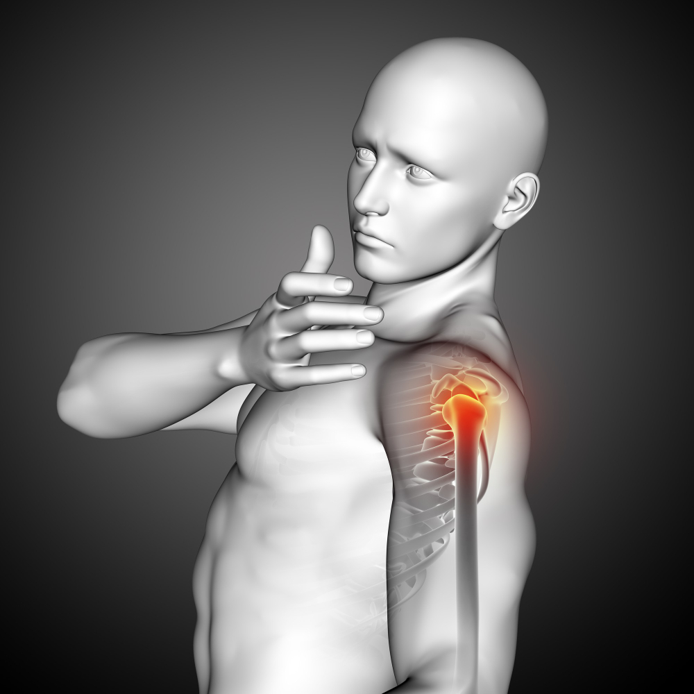 Shoulder Instability in Miami