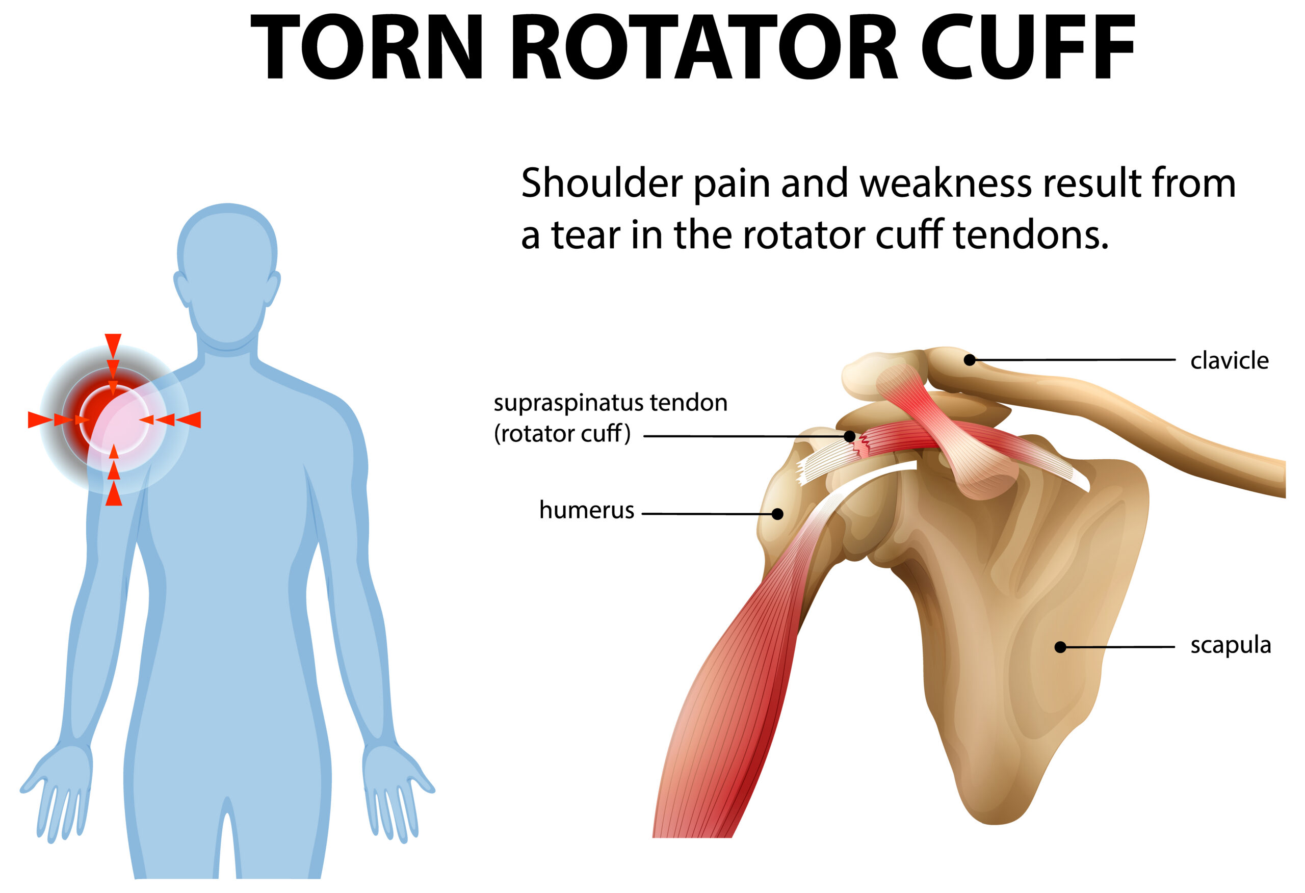 rotator cuff tear