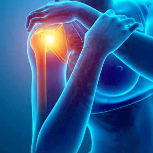 X-ray of shoulder Impingement