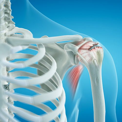 Xray of rotator cuff tear
