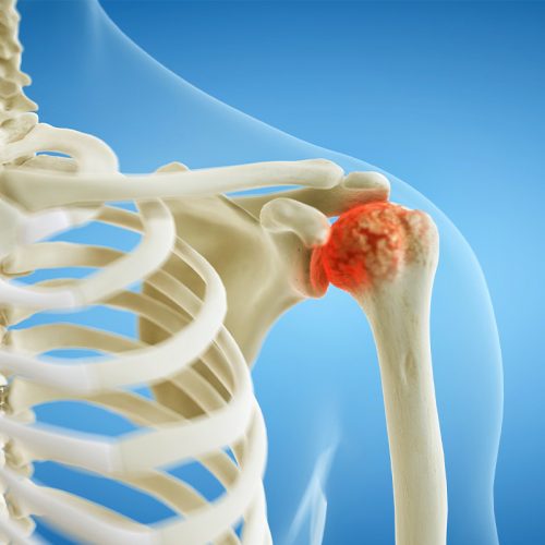 Image of Shoulder arthritis