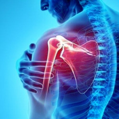 Xray image of Shoulder Instability